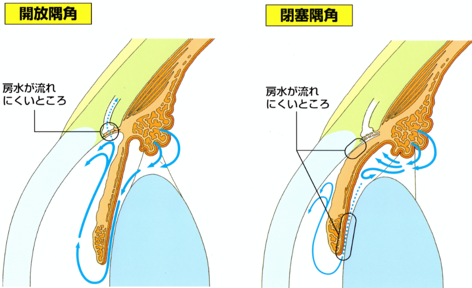 開放隅角と閉塞隅角