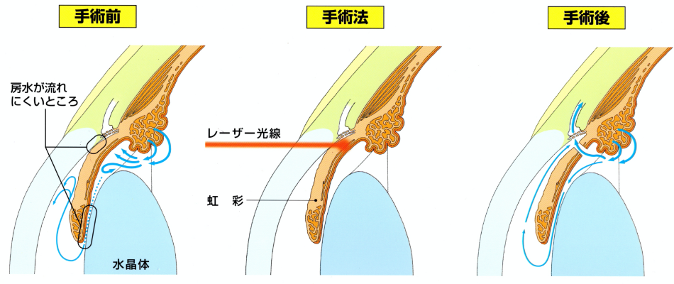 手術前・手術法・手術後