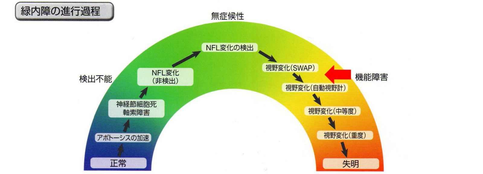 緑内障の進行過程